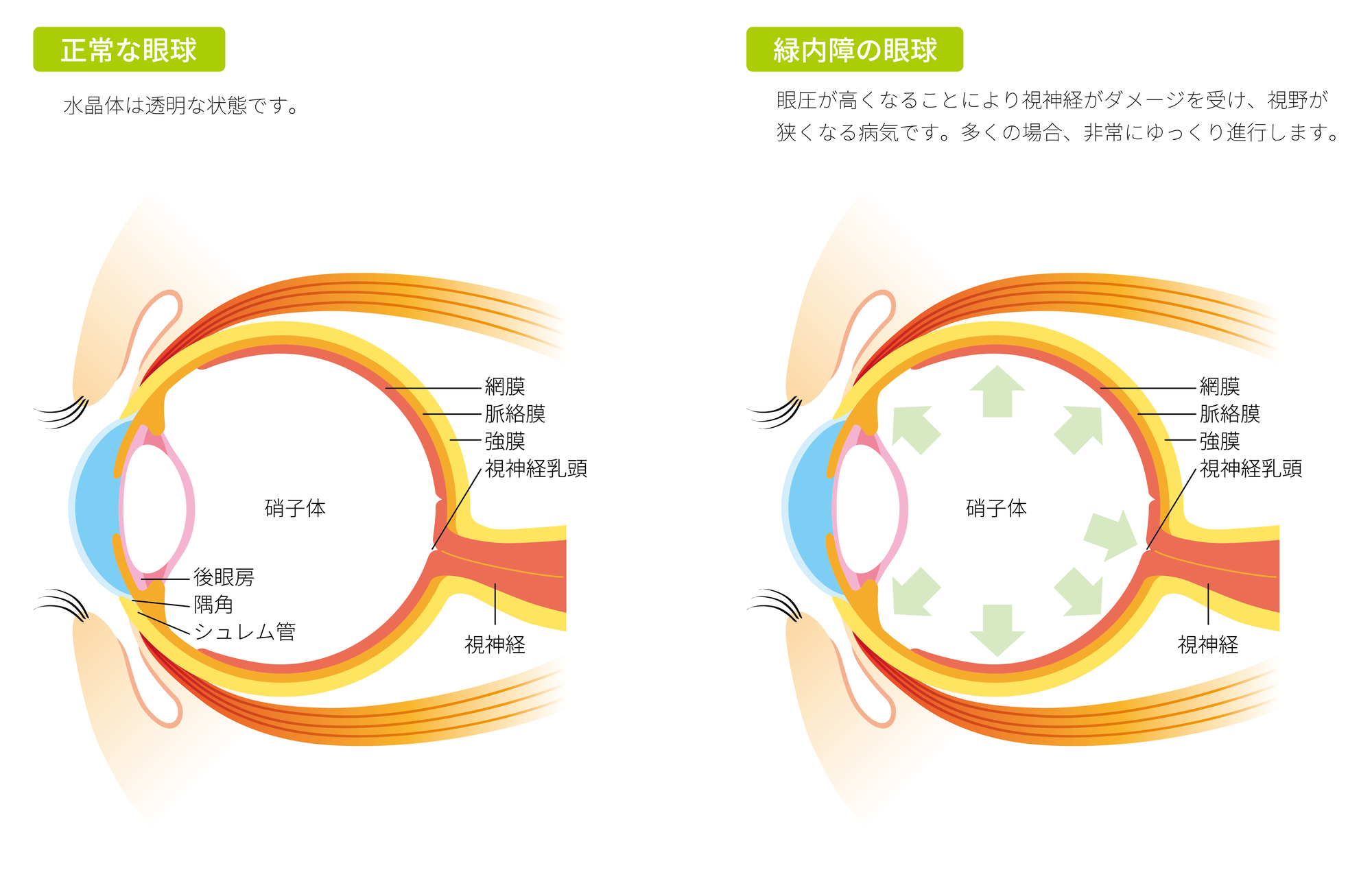 開放隅角緑内障の治療